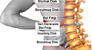 Resimde: Bel;Omurlar,normal disk,incelmiş disk,bozulmuş disk,Bel fıtığı ve ileri derecede bel fıtığı görülmektedir.